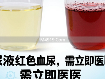 小便泡沫长久不散是咋回事？快来看尿液里隐藏的健康信号