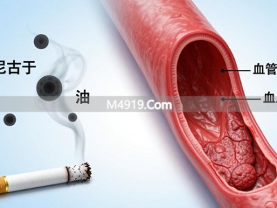 预防脑梗关键措施大揭秘：控制基础病等四项你得知道